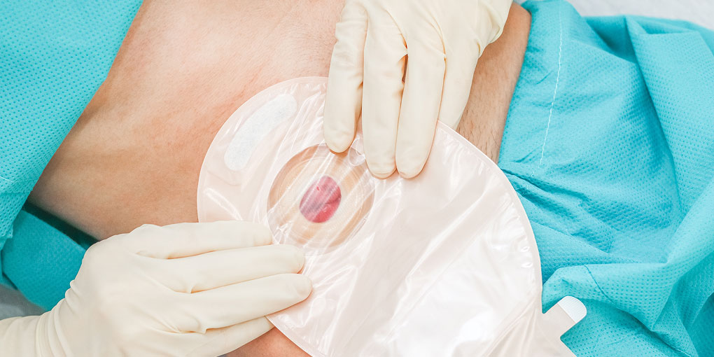 Living Confidently and Independently With an Ostomy